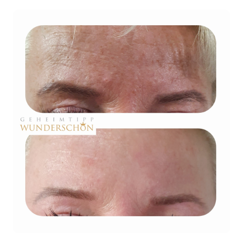 Anwendung der Warmplasma-Technologie zur Hautpflege – fördert Durchblutung und Zellregeneration für eine gesunde, vitale Haut.